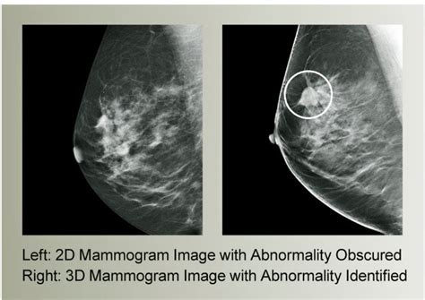 the villages breast mammogram